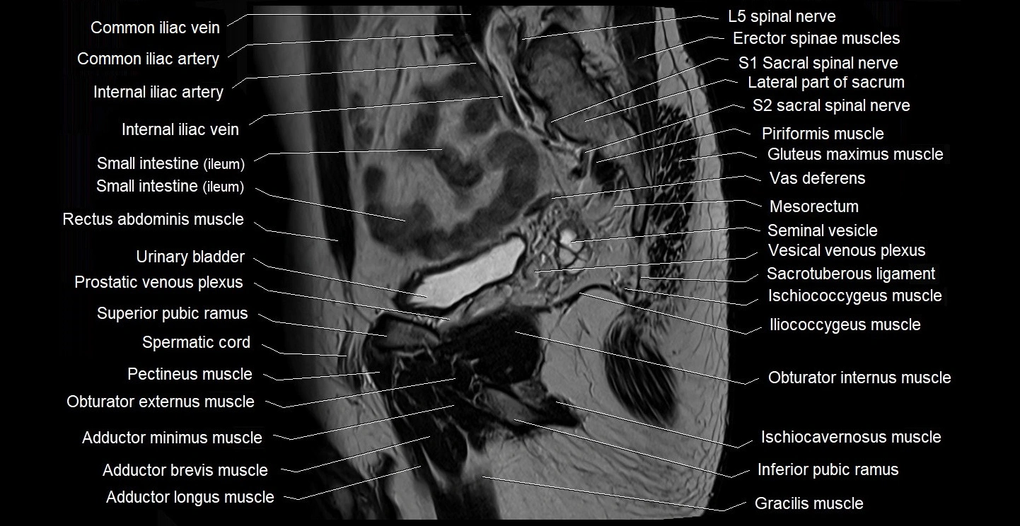 male pelvis sagittal cross sectional anatomy 3T mri image 31.webp